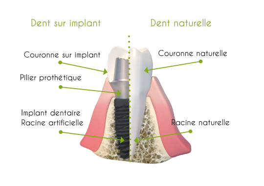 dent-implant